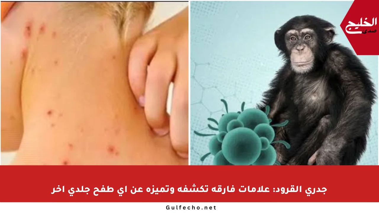 جدري القرود: علامات فارقة تكشفه وتميزه عن أي طفح جلدي آخر